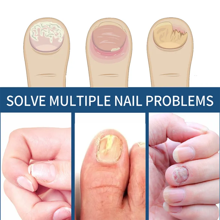 Fungal Nail Patches (Free Delivery 🚚)