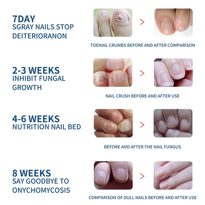Fungal Nail Patches (Free Delivery 🚚)
